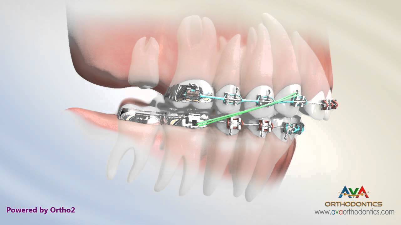 How Braces Work- Elements of the orthodontic treatment and its role © 