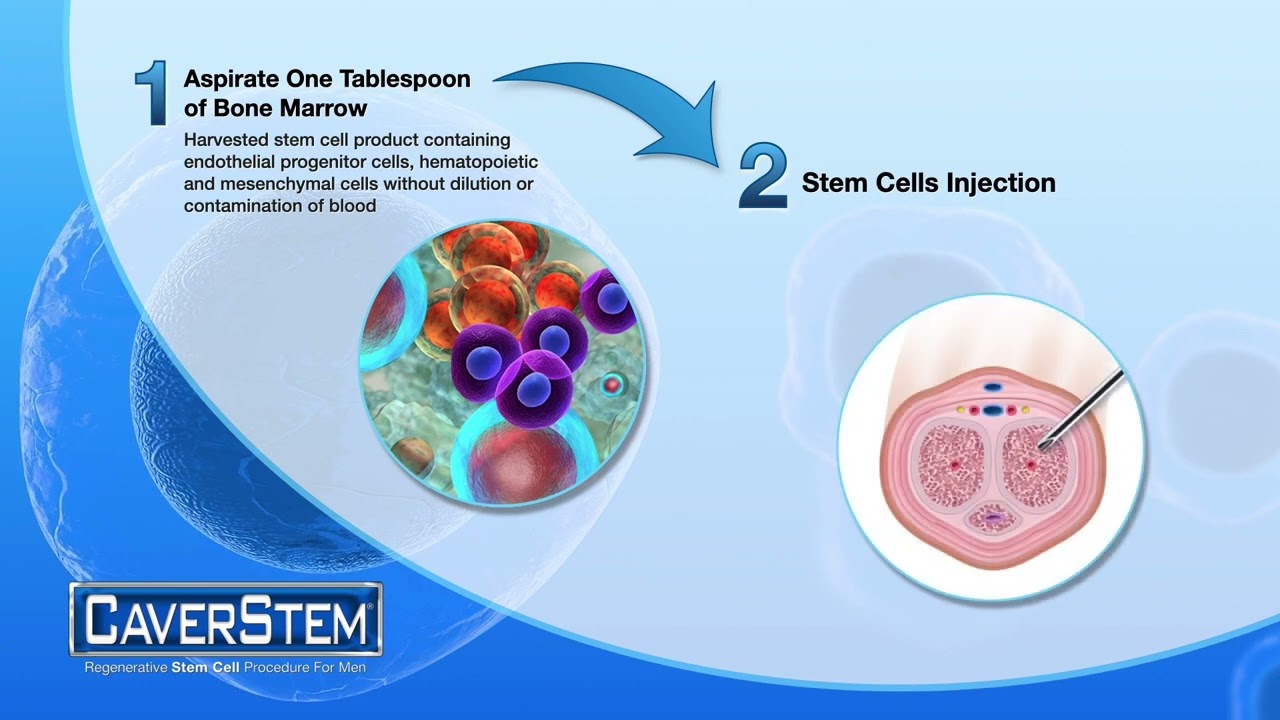 CaverStem® STEM Cell Therapy for Erectile Dysfunction