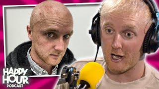 Theo Baker HONEST Opinion On His Hair Transplant