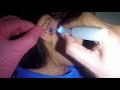 Girl's Earwax Removed Slowly & Gently In One Piece