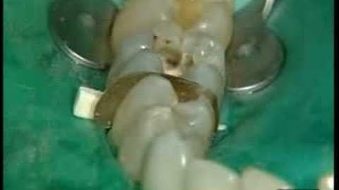 Restauración de Posteriores Dr. P.Colon - Quixfil /1