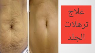 التخلص من ترهلات الجلد بعد خساره الوزن / كيفيه  التخلص من الجلد الزائد