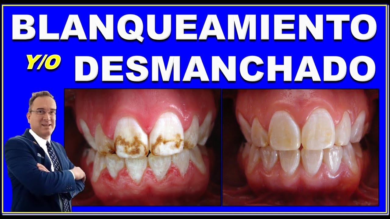 КОМБИНИРОВАННЫЙ МЕТОД ОТБЕЛИВАНИЯ (ОКРАШИВАНИЯ) ЗУБОВ