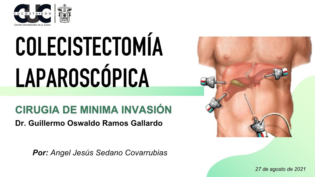 Colecistectomia Laparoscopica Colecistectomia Laparoscopica: Guida