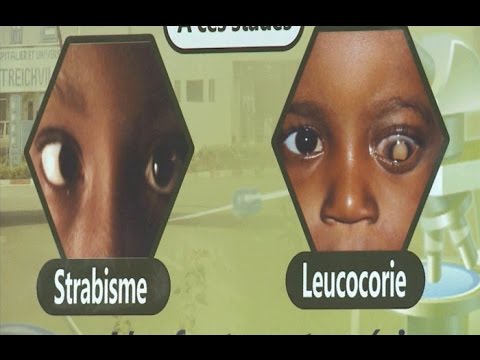 Vidéo: Rétinoblastome Chez Les Enfants - Traitement, Diagnostic, Causes