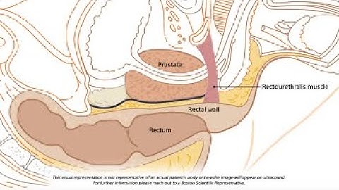 SpaceOAR™ Hydrogel Procedural Animation