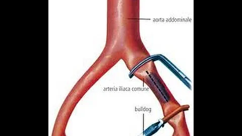 Como é feito a Embolectomia?
