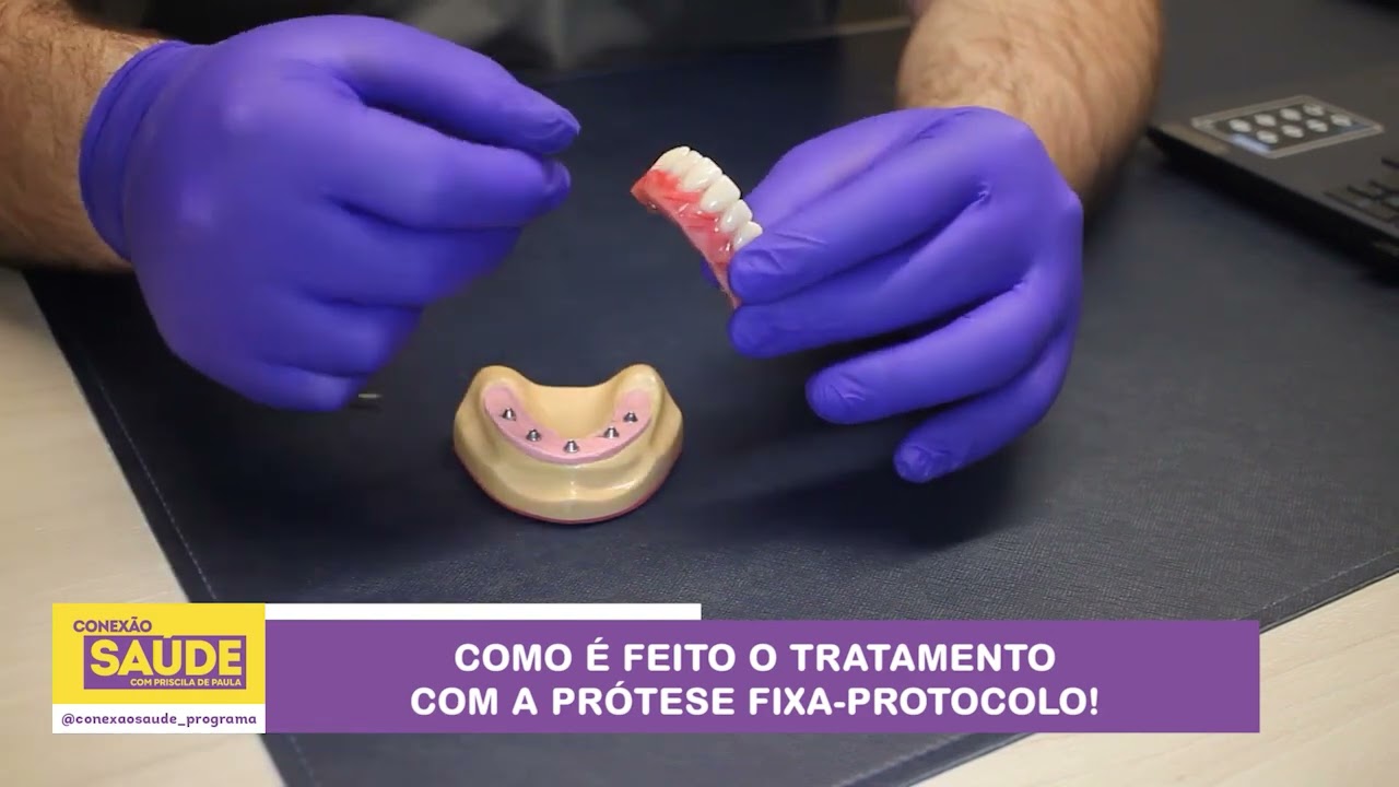COMO É FEITO O TRATAMENTO COM A PRÓTESE FIXA-PROTOCOLO!