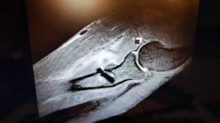 Vlog Year 1.5 Recovery Following Distal Bicep Tendon Rupture Complications Mri Results