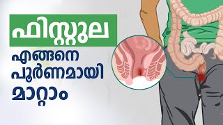 ഫസററല എങങന പർണമയ മററ What Is Fistula Best Treatment For Fistula