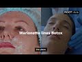 Smooth Marionette Lines with Botox in Flower Mound &amp; Coppell, TX