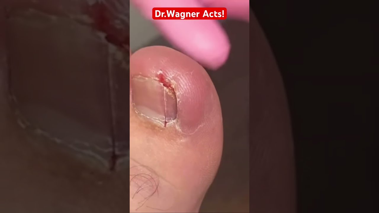 YOU MAY NOT BELIEVE THE SIZE OF THIS INGROWN TOENAIL Shorts