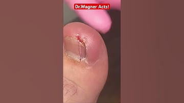 YOU MAY NOT BELIEVE THE SIZE OF THIS INGROWN TOENAIL🤯#shorts