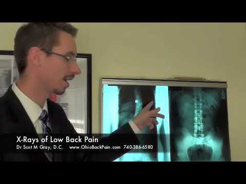 Dr. Scot Explains An X-Ray of a Patient With Low B...