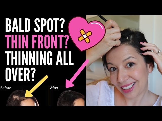 Quick way to fix your patchy or uneven hairline if yours look like min... |  TikTok