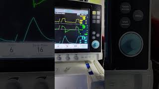 वेंटिलेटर चलाना सीखें सिर्फ एक मिनट में #ventilater setting in one minute in ICU#doctor #hospital