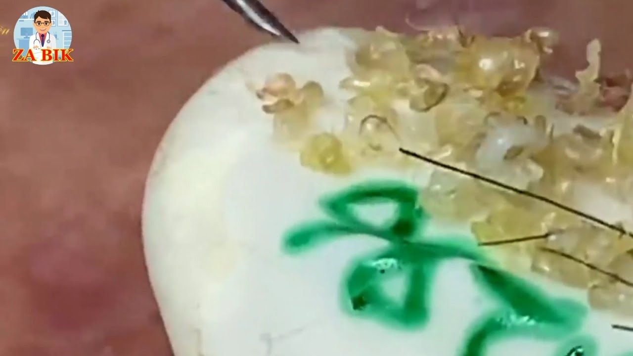 blackheads around lip line EP.02 YouTube