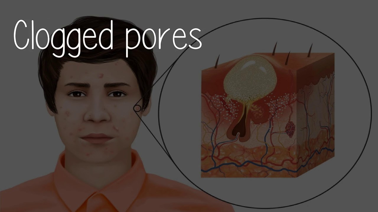 Can The Bed Sheets I Use Be The Cause Of My Acne? YouTube