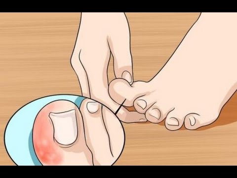 ¿Conoces qué es la Paroniquia? Pliegue de la uña doloroso, enrojecido e hinchado dieta cetogenica