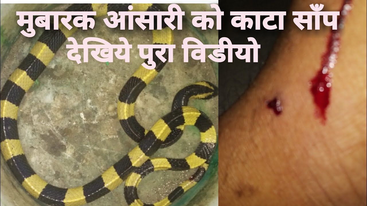 cobra rescue litters मुबारक आंसारी को काटा साँप लौगो ने मांगे दुआ गोमो के नामी गेराज मिस्त्र मुबारक आंसारी को उनके बेड