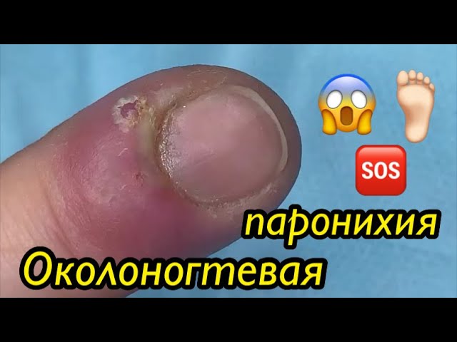 Околоногтевая паронихия 😱🆘⚠️❗️🦶🏻