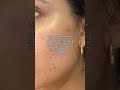Why your Acne is worse⁉️