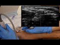 Ultrasound guided iv tutorial