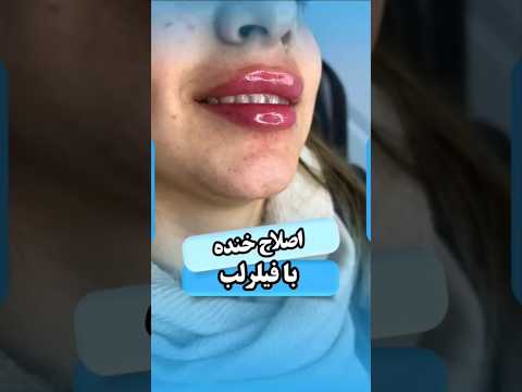 در این کیس باتزریق فیلر لب لبخند لثه ای اصلاح شد فیلر لب لب لبخند تهران دکتر نوید موسوی