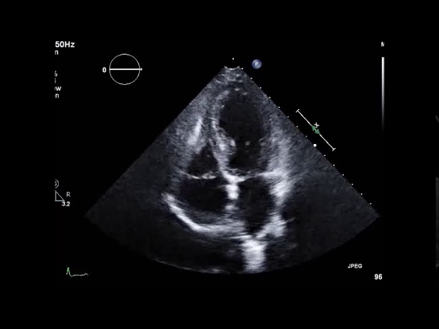 Transthoracic Echocardiography: Takotsubo cardiomyopathy 1 (4ch