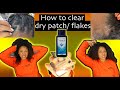 How to clear dry patches/flakes on scalp | deep clean| my scalp was not clearing up until this! 2020