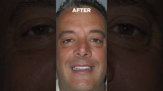 Giuseppe had missing, broken teeth & needed zygomatic implants for bone loss.  Looking fantastic!