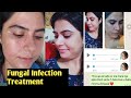 Fungal infection treatment  by natural beauty hair treatment  komal arora