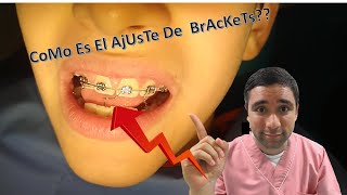 Como se ajustan los brackets y los elásticos de colores en ortodoncia? Dentición MixTA! 😎
