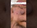 【毛穴エクストラクション】メンズさんのビフォーアフター #shorts