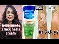 Crack heels home remedy cream | in 3 days reduce cracked heels completely