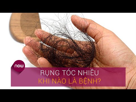 Bị Rụng Tóc Nhiều - Rụng tóc nhiều: Bệnh lý hay tình trạng sinh lý bình thường? | VTC Now