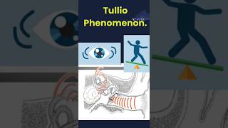 When Sound Makes You Dizzy: The Tullio Phenomenon Explained