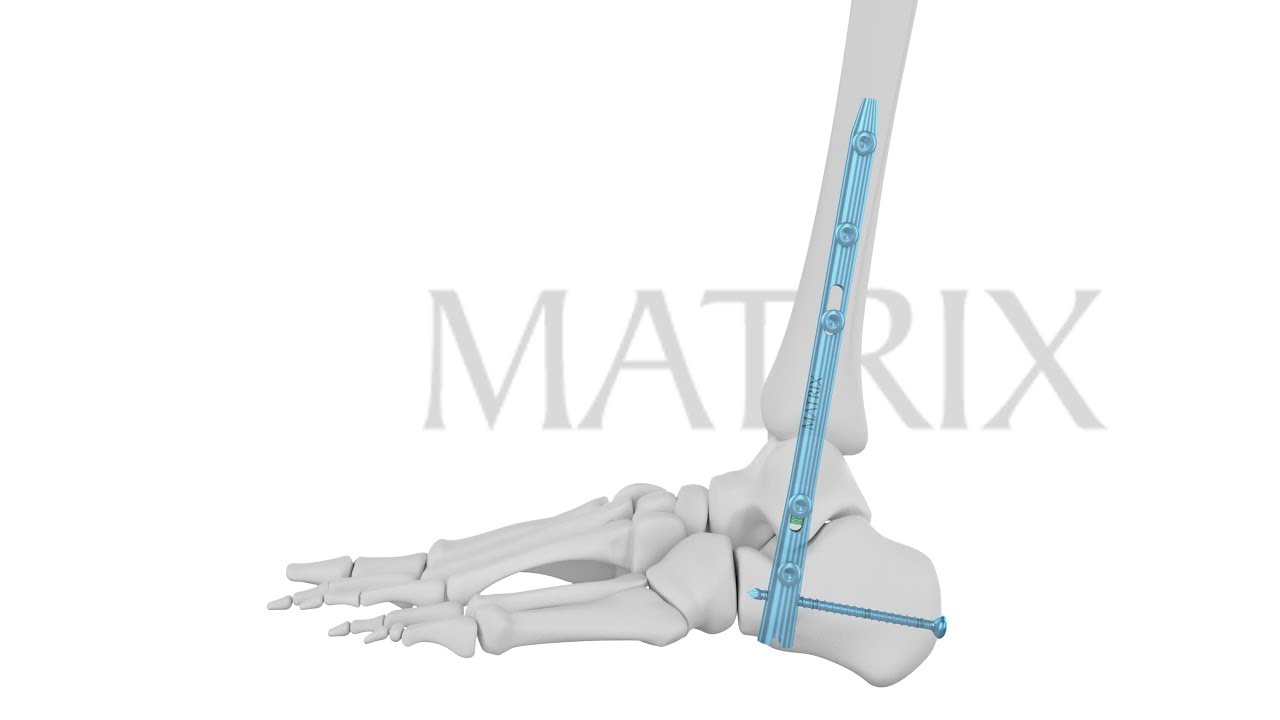 JBJS: Tibiotalocalcaneal Arthrodesis with Intramedullary Fibular Strut  Graft and Adjuvant Hardware Fixation