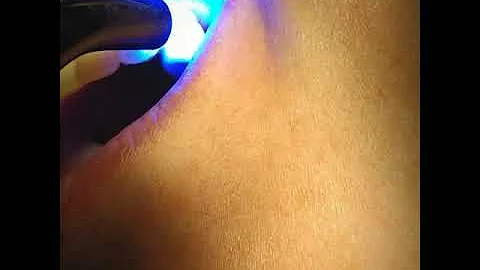 Tem como consertar dente de porcelana?