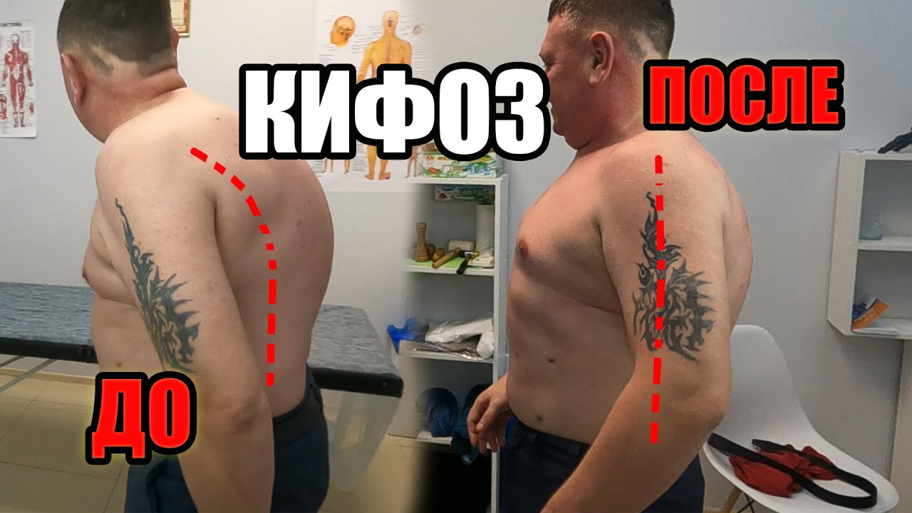 Как убрать горб за 20 минут. Костоправ Оренбург - YouTube