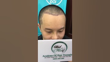 hình ảnh cấy tóc thực tế blackhair