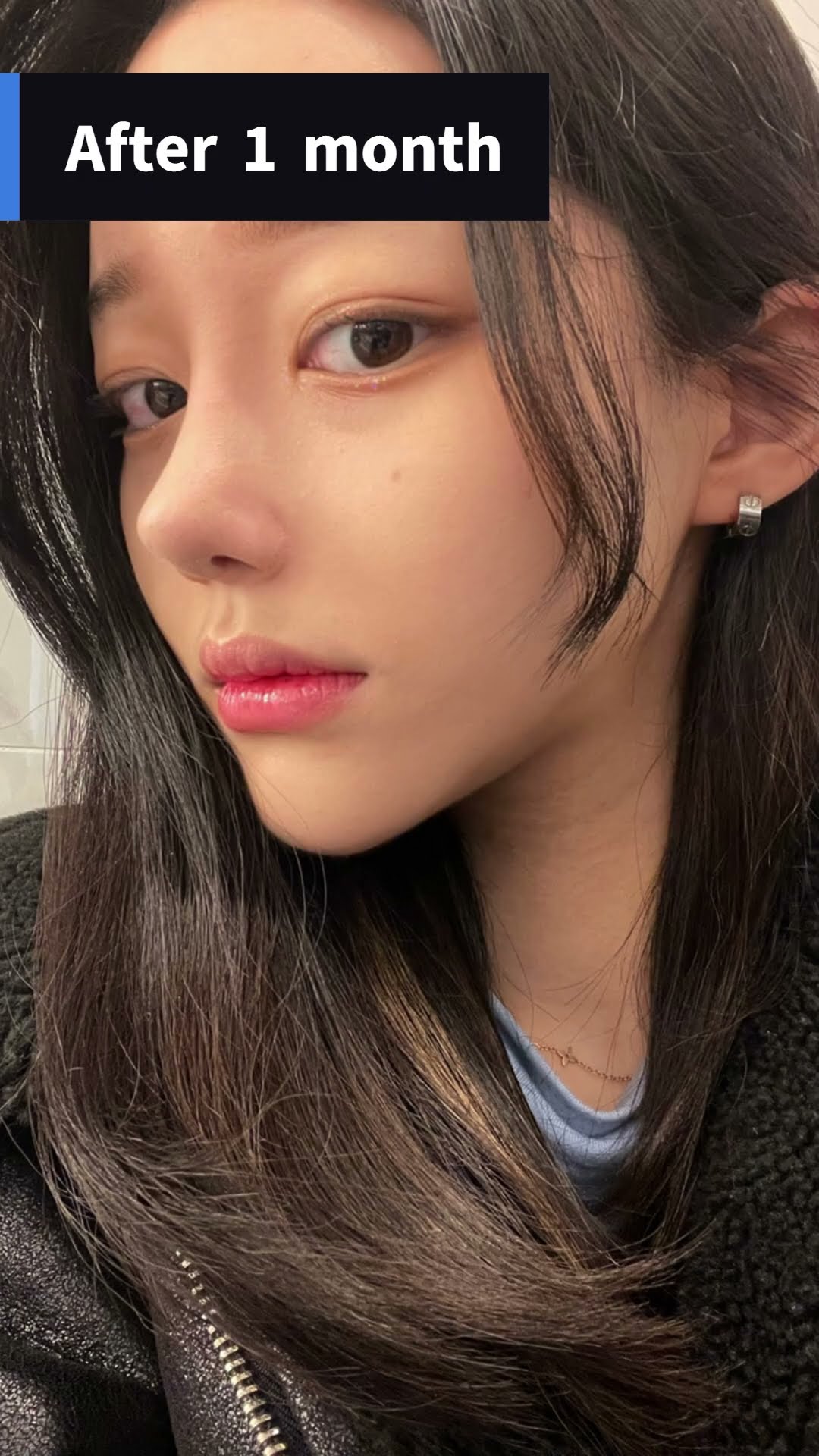 [Cheekbone + Revision Rhinoplasty] Plastic Surgery Before & After