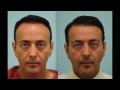 Dallas Corrective Megasession with Temporal Points Hair Transplant Testimonial Follow Up