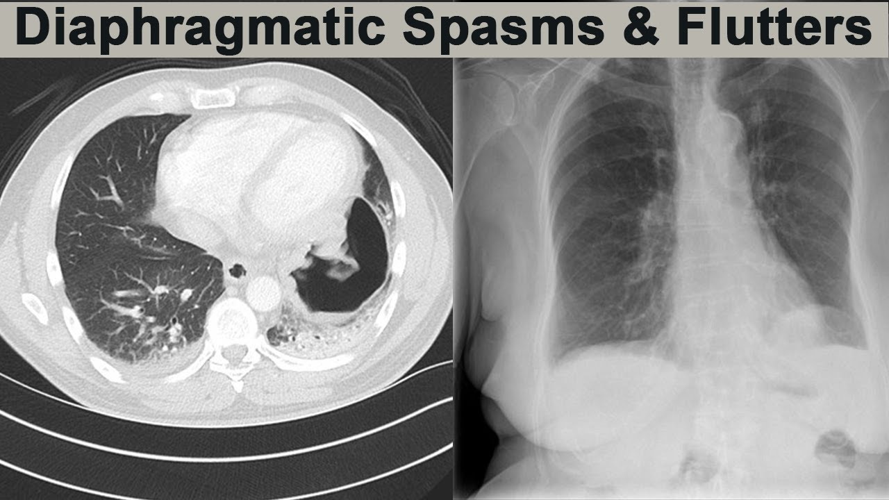 Symptoms Of Diaphragmatic Spasms And Flutters Youtube