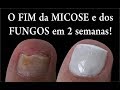 O FIM DAS MICOSES E FUNGOS NAS UNHAS EM 2 SEMANAS Feat.  Kátia Rosenberg por Joyce Vignochi