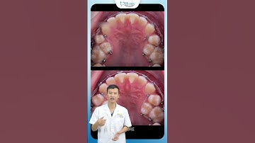 Niềng Răng Khấp Khểnh Về Đúng Khớp Cắn| Bác Sĩ Yên