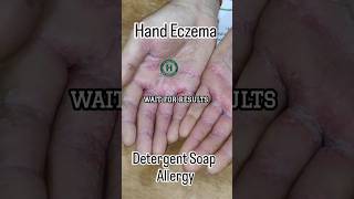 Hand Eczema from Soap &amp; Detergent Allergy | 5 Days Improvement | Homeopathy Treatment