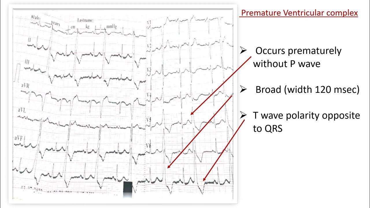 Ecg basics i premature ventricular complex pvc i bigeminy youtube