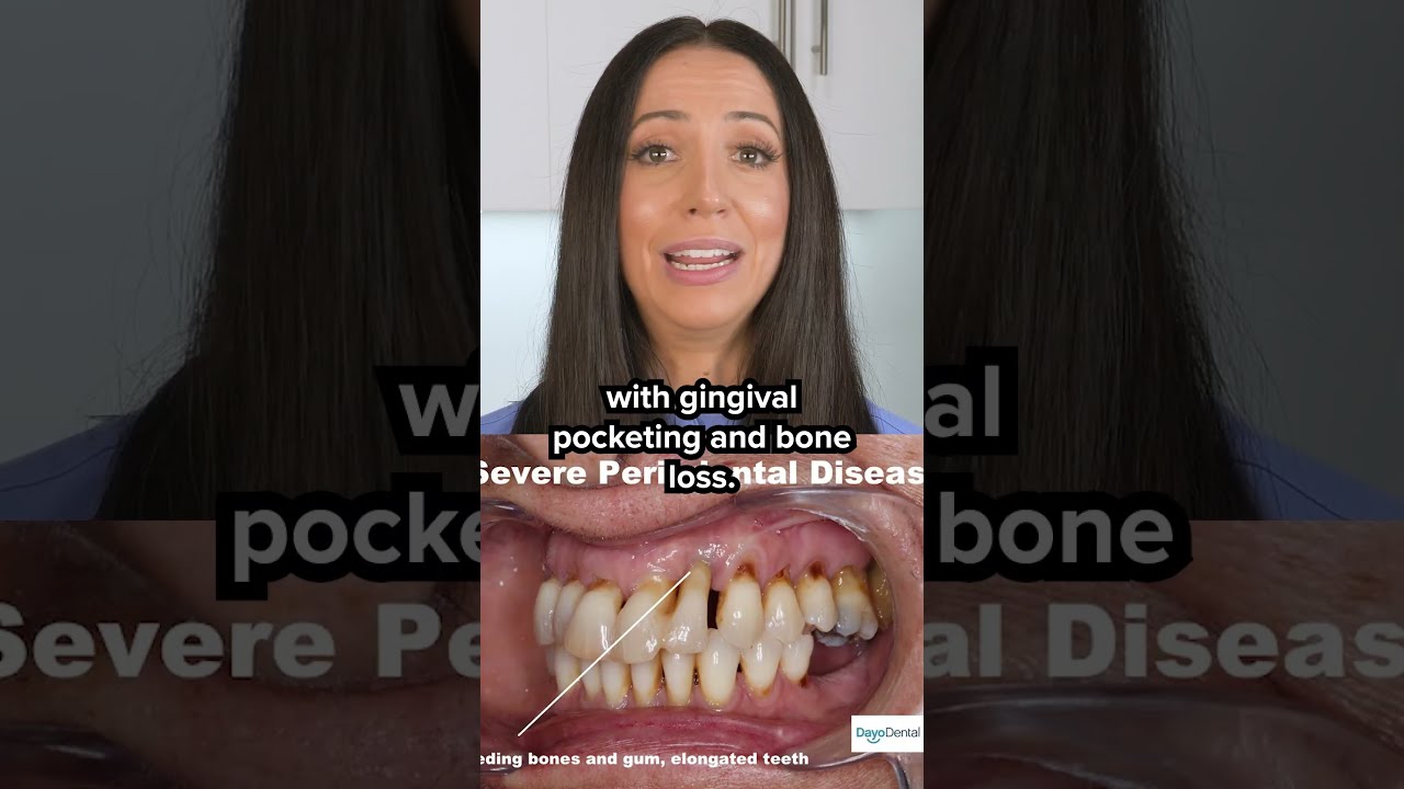 if you have gum disease, do this! #shorts
