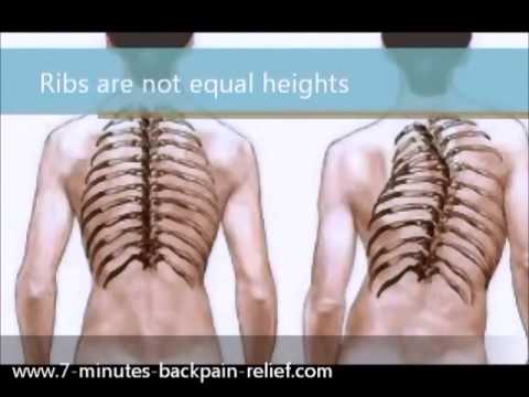 What Scoliosis 48 Degree Curve